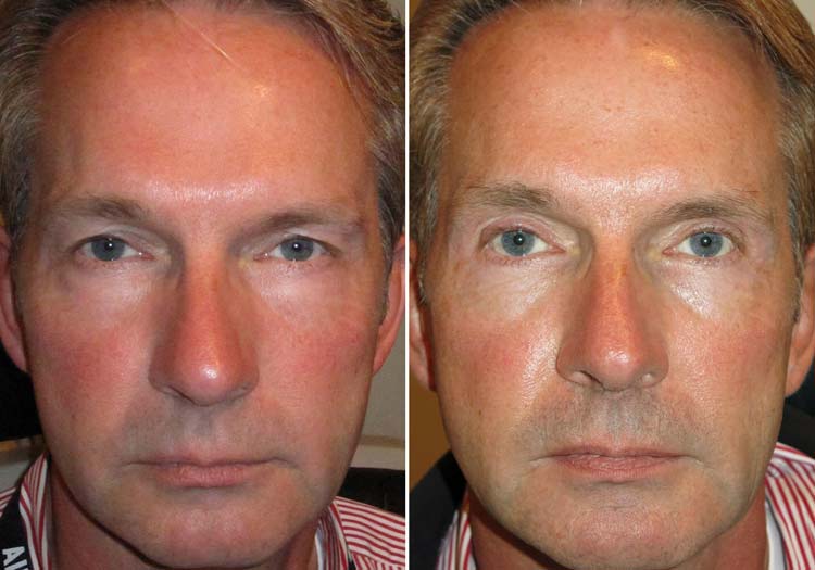 Cosmetic Surgery Trends - Beards & Blepharoplasty