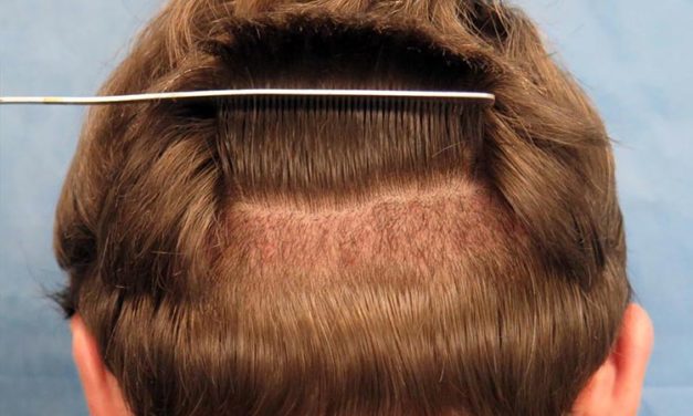 Unshaven Hair Transplant – Facts You Should Consider!