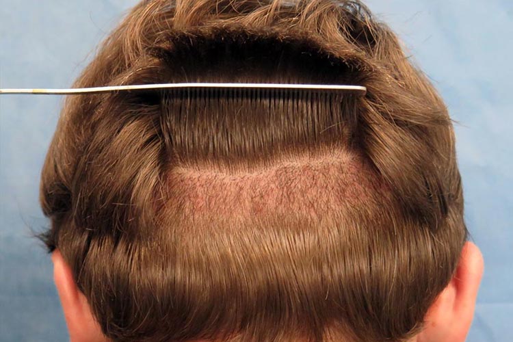 Unshaven Hair Transplant – Facts You Should Consider!
