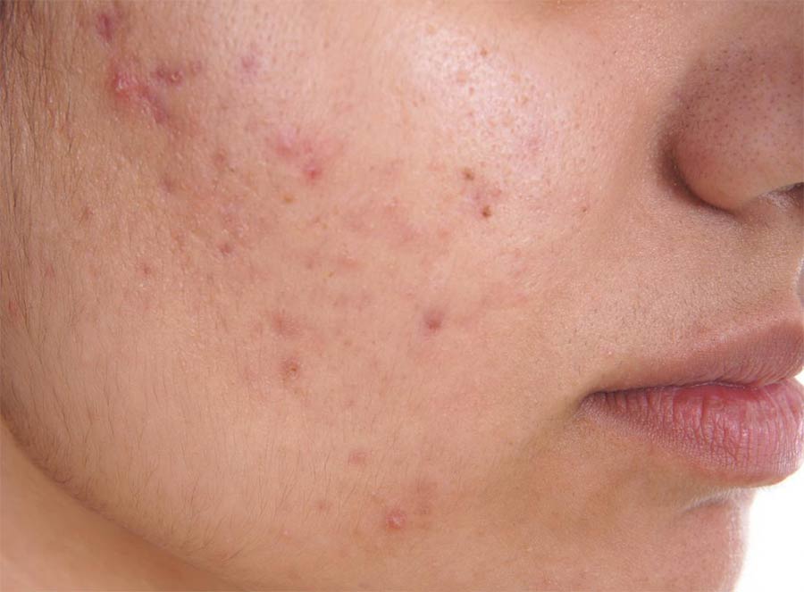 Acne help to get rid of it with CBD cream
