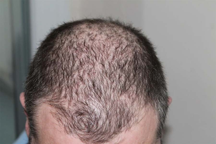 Hair Loss Remedies for Men