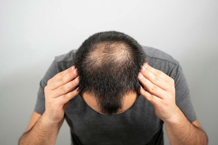 signs of balding